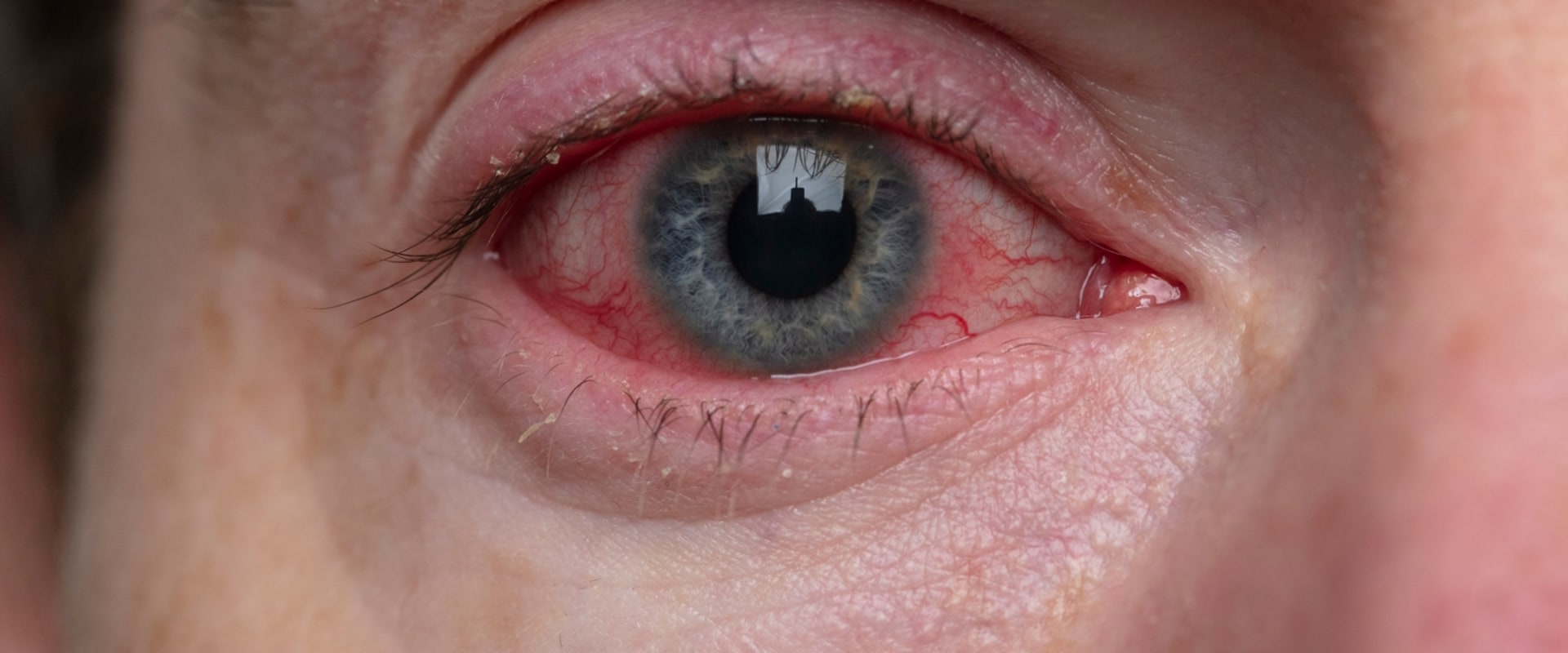 Do eyelid wipes help blepharitis?