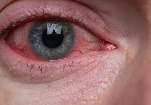 Do eyelid wipes help blepharitis?