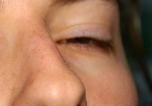 Do eyelid wipes help chalazion?