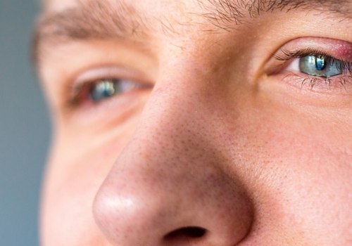 Do eyelid wipes help stye?