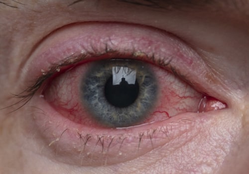 What do blepharitis wipes do?